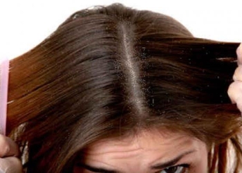 5 طرق للتخلص من قشرة الشعر نهائيا