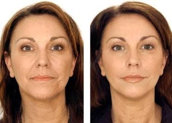 9 طرق طبيعية للتخلص من تجاعيد البشرة