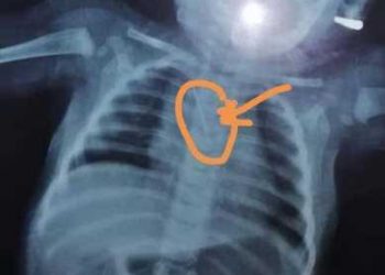 استخراج دبوس من القصبة الهوائية لطفل ٦ شهور بمستشفى بنها الجامعي