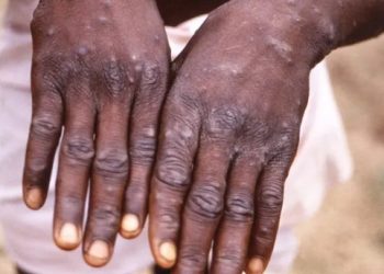 السودان: تسجيل أول إصابة مؤكدة بجدري القردة