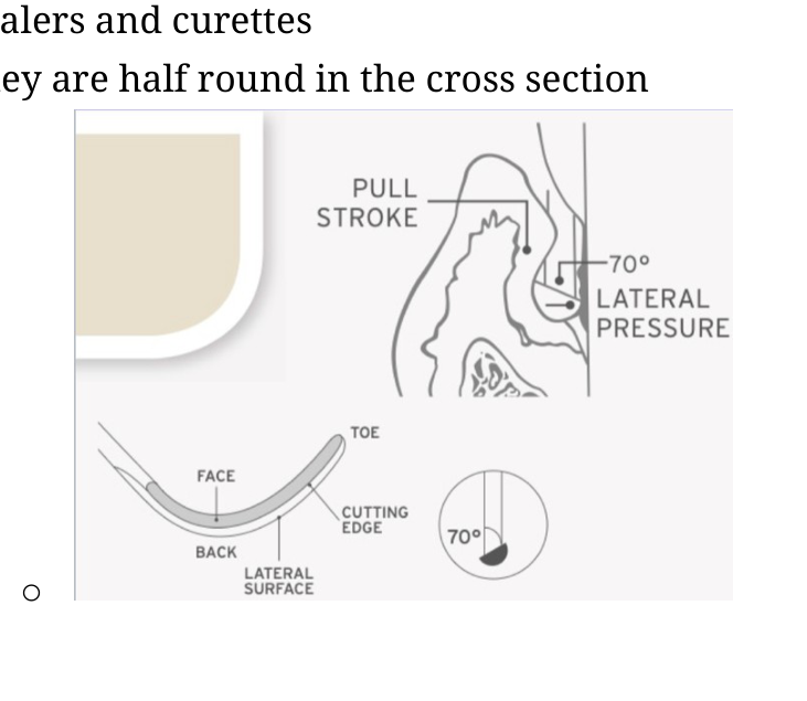 Curette cross-section