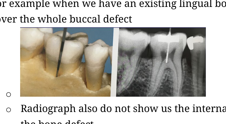 Comparison of a clinical model and radiograph illustrating how 2D images can obscure bone defects.