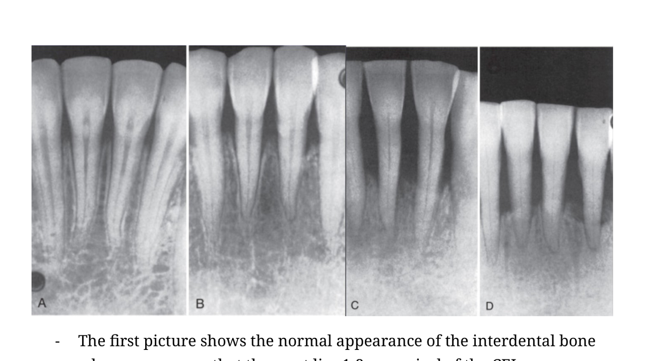 Progression of periodontal bone changes