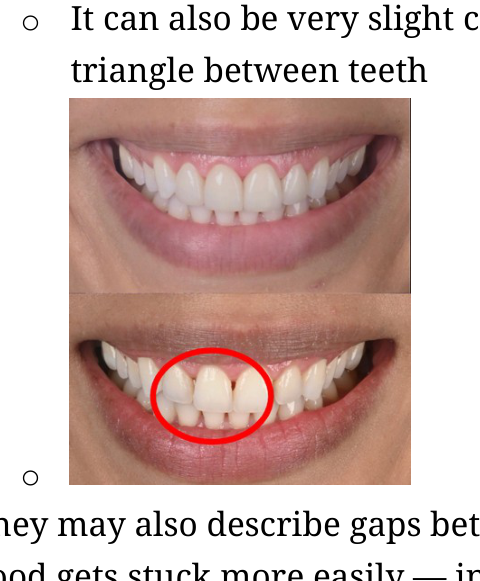 A close-up photograph of a smile with a red circle highlighting gingival recession between teeth.