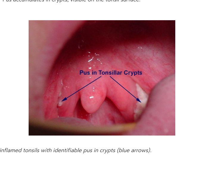 Pus in Tonsillar Crypts