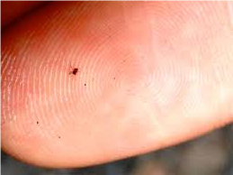 Chigger bite and parasitic track images