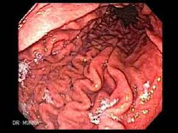 Endoscopic view of the stomach