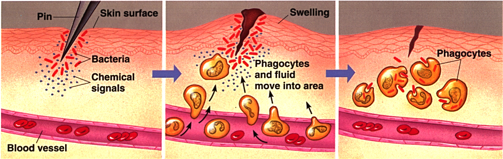 Diagram illustrating the process of inflammation