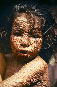 Image of a child suffering from Small Pox (Variola Virus).