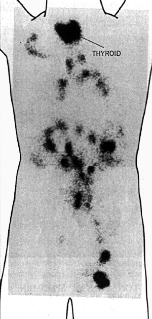 Thyroid scan image