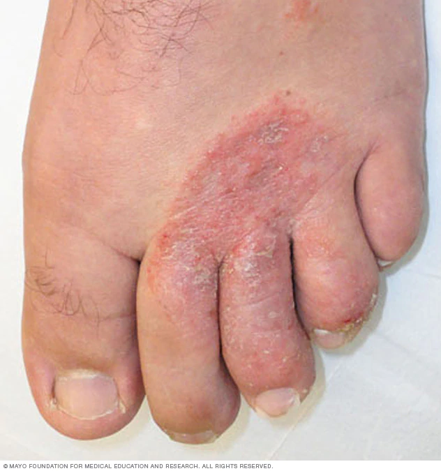 Fungal infection on foot