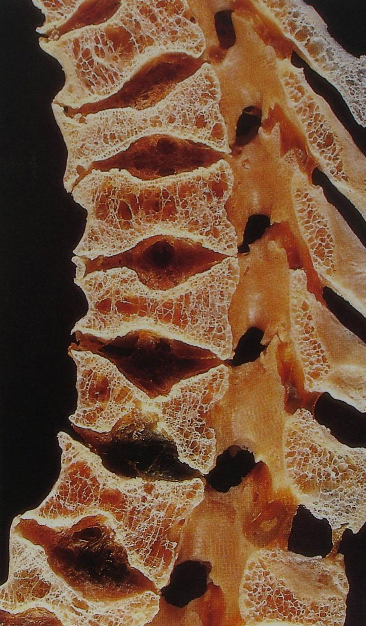 spine with multiple vertebral fractures