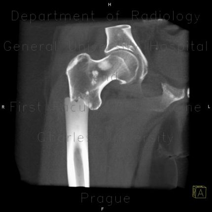 radiograph showing hip and prosthesis