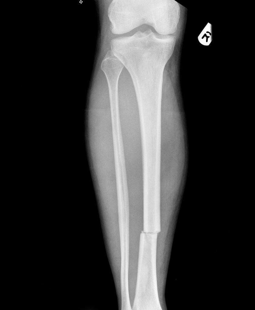 transverse fracture image