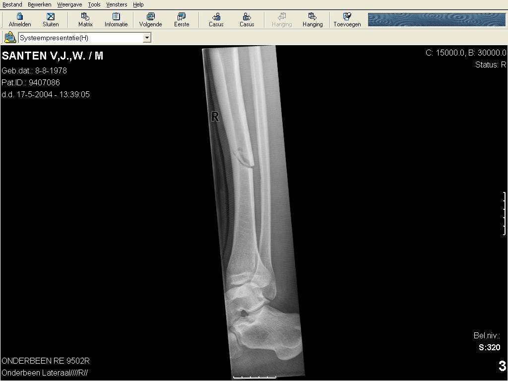 spiral fracture image