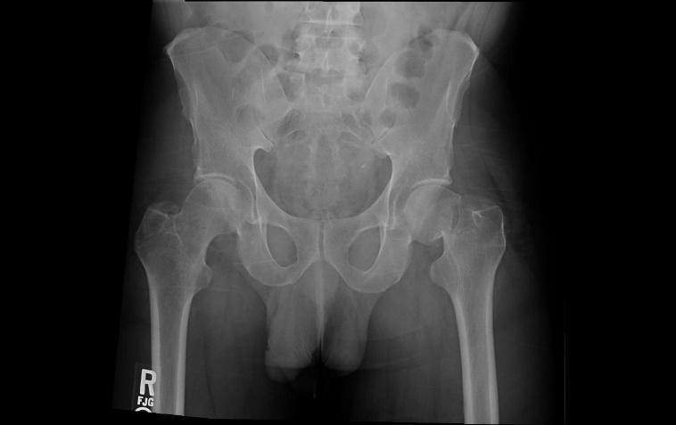 Pelvis X-ray showing labeled pelvic bones and femoral neck fracture