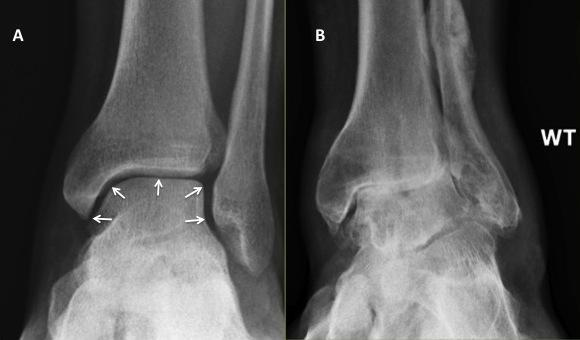 ankle injuries X-rays