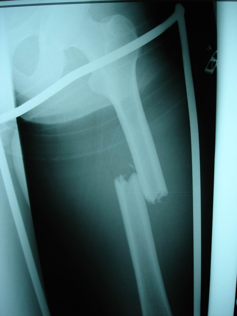 X-ray image of a leg fracture