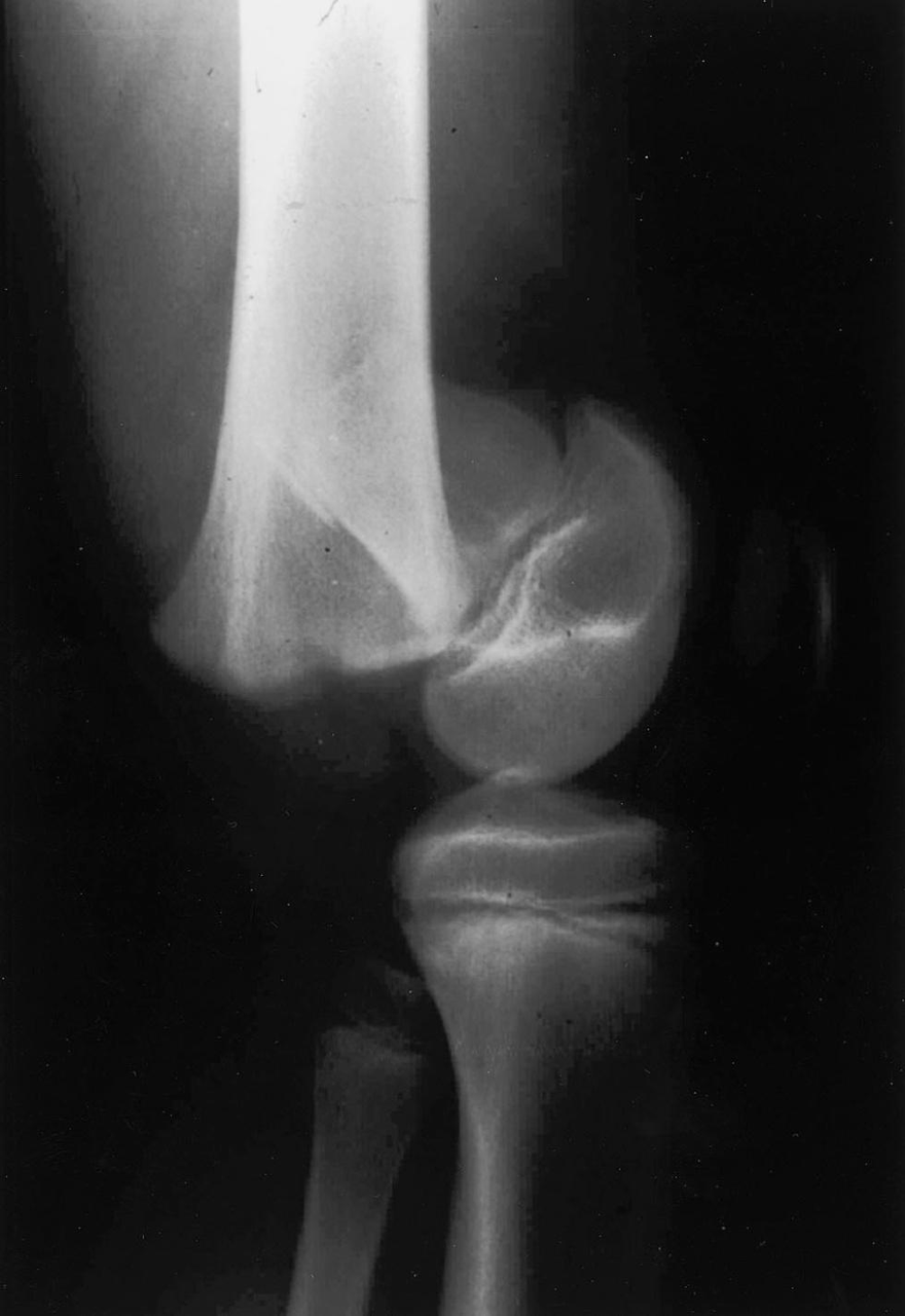 knee fracture X-ray