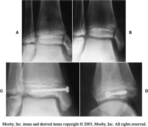 X-ray of tibia/ankle fractures and hardware