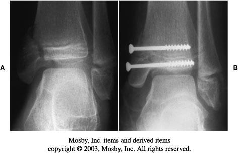 ankle X-ray with hardware