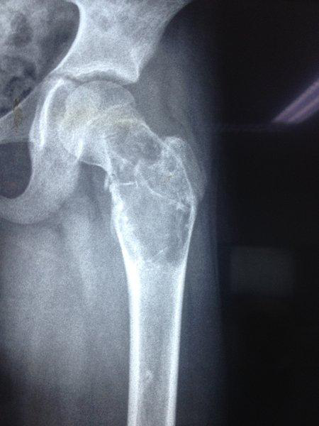X-ray of hip showing an osteolytic lesion