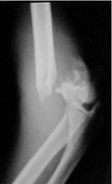 elbow x-ray