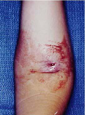 wound photograph