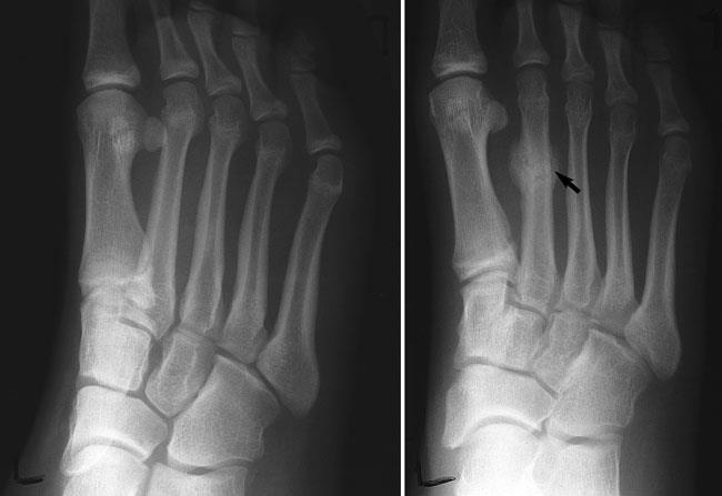 X-ray showing a stress fracture in the foot