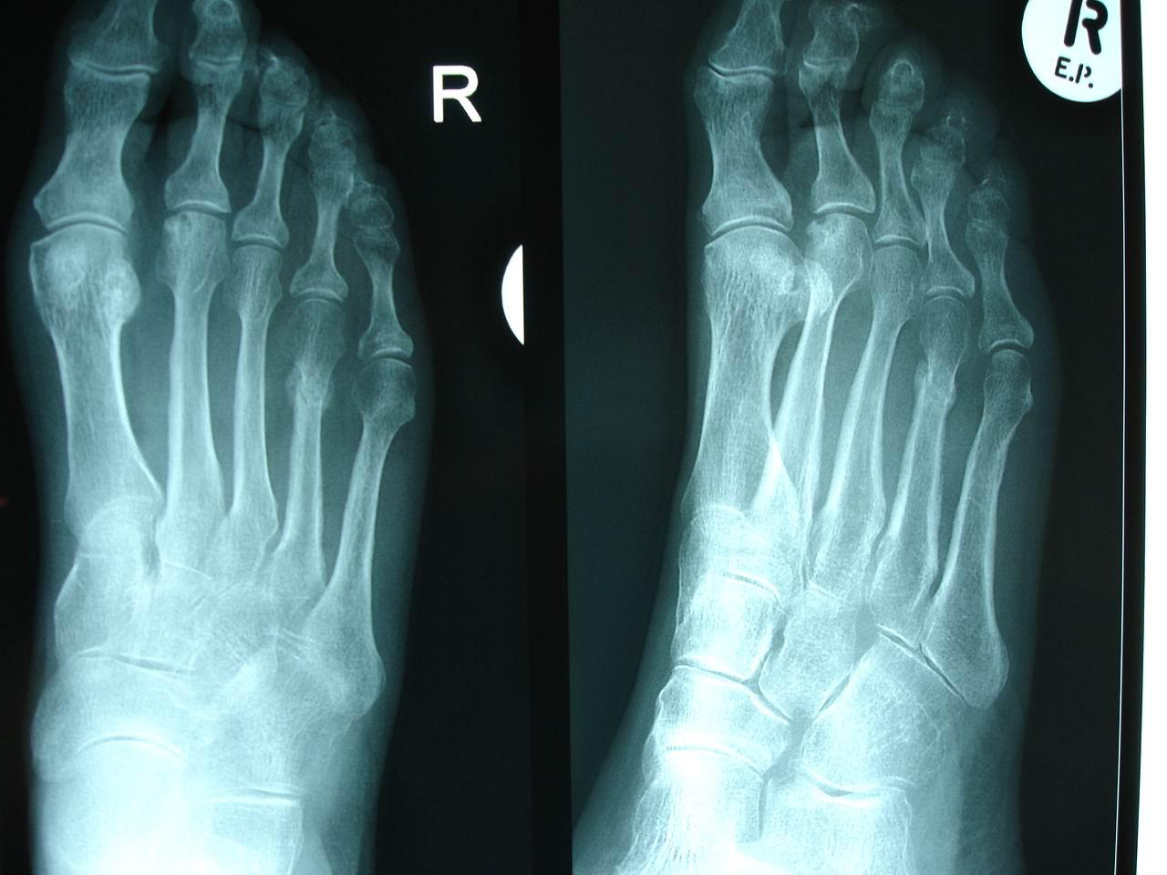 X-ray feet