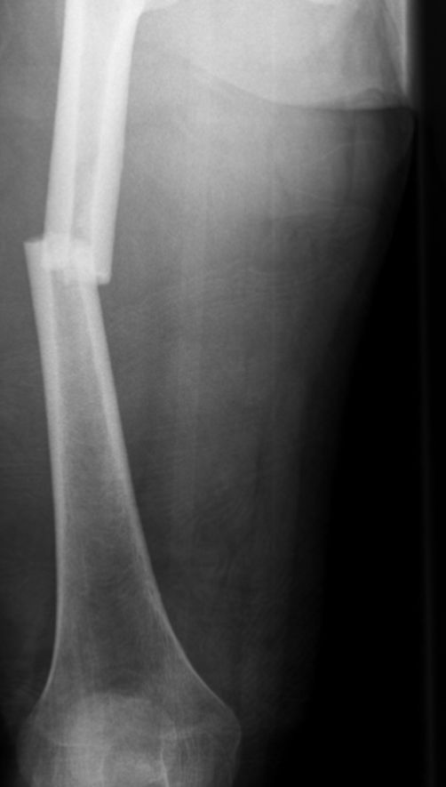 Simple fracture X-ray