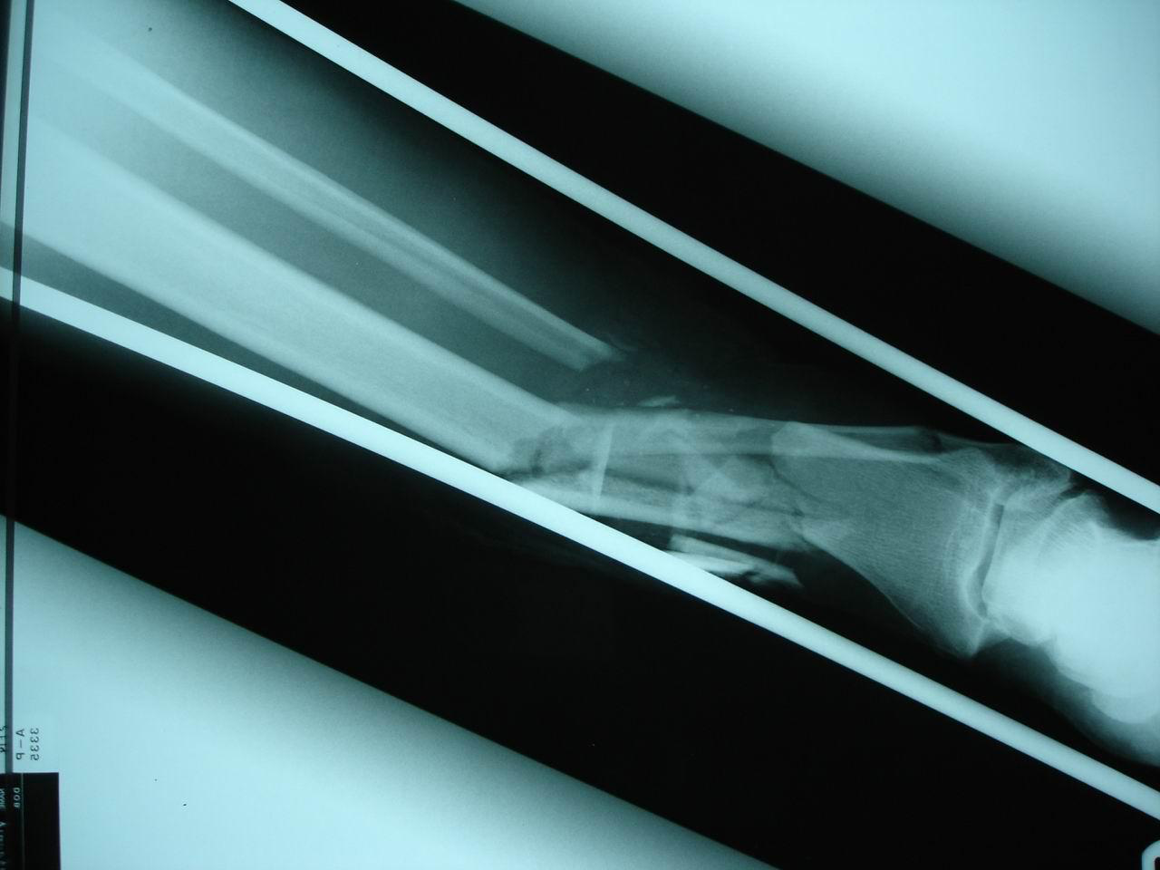 Comminuted fracture X-ray