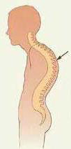 Abnormal spinal curvatures