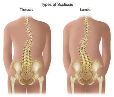 Types of Scoliosis