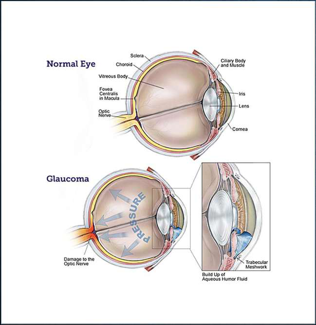Diagrams comparing a normal eye with an eye affected by glaucoma.
