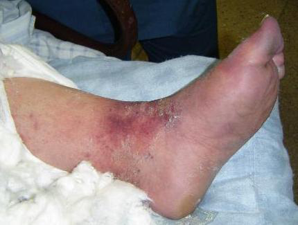 Anticoagulantes