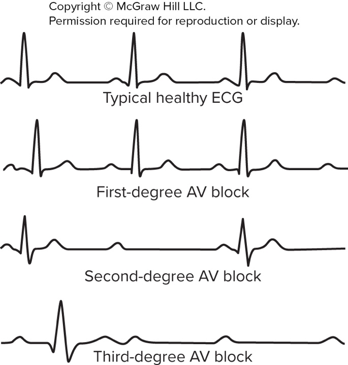 ECG examples including healthy ECG and AV blocks