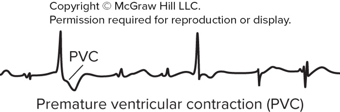 Premature ventricular contraction ECG