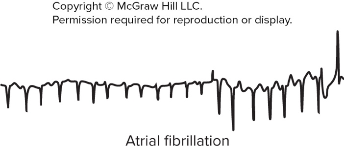 Atrial fibrillation ECG