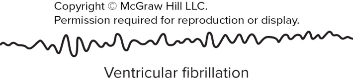 Ventricular fibrillation ECG