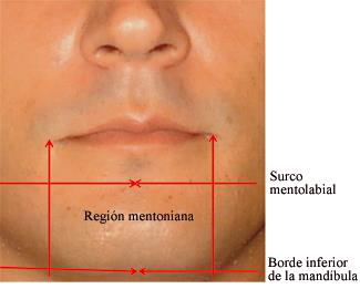 Región mentoniana con surco mentolabial