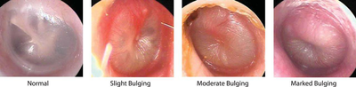 Comparison of otoscopic findings in otitis media, showing normal, slightly bulging, moderately bulging, and markedly bulging tympanic membranes.