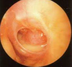 Photograph of a perforated tympanic membrane with a visible pocket of pus in the middle ear.
