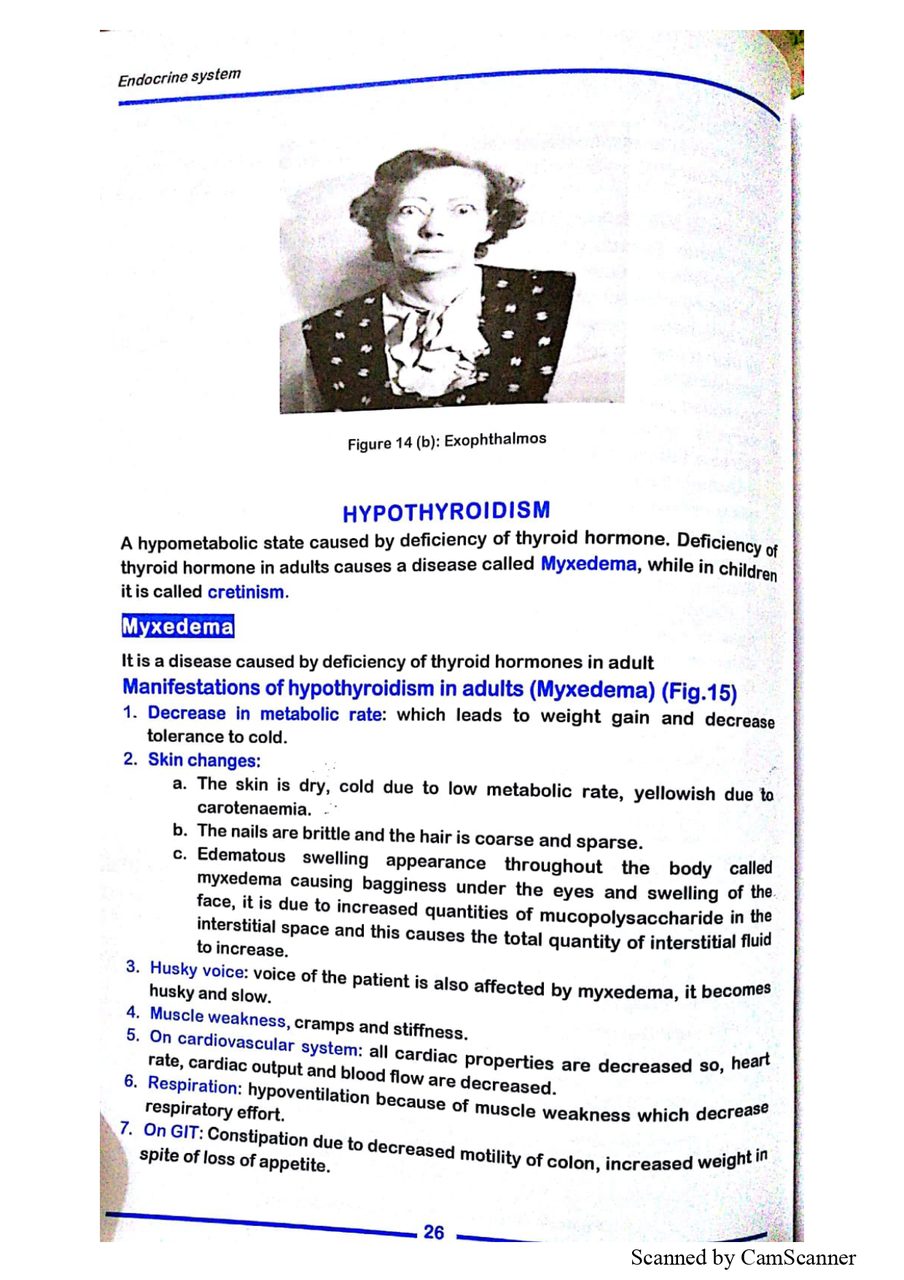 Photograph and text explaining Myxedema