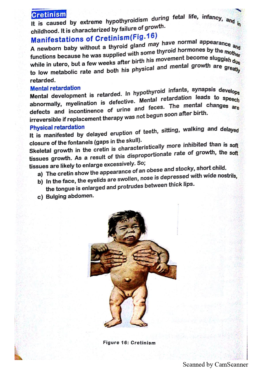 Cretinism: congenital hypothyroidism features