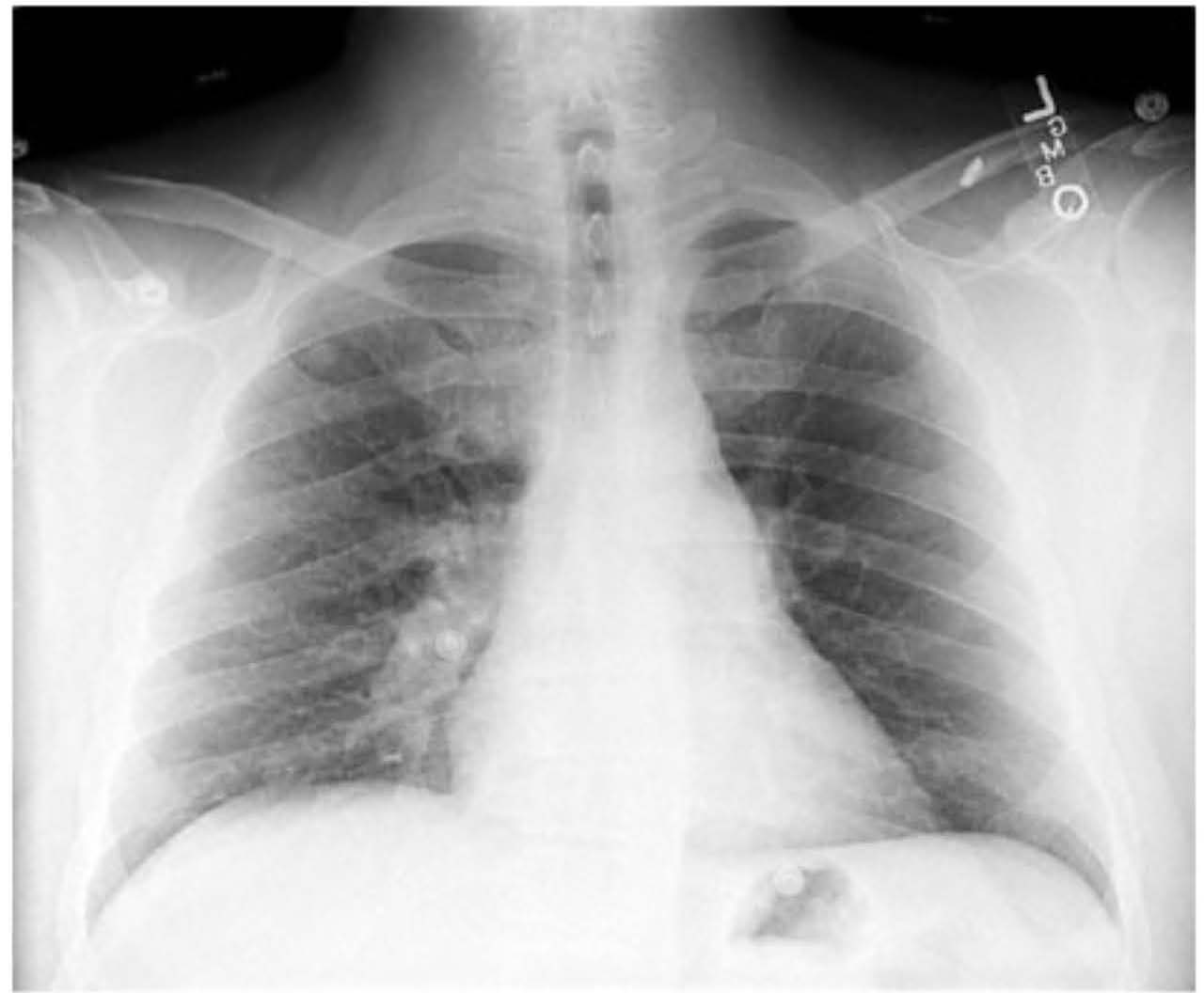 X-ray of a chest