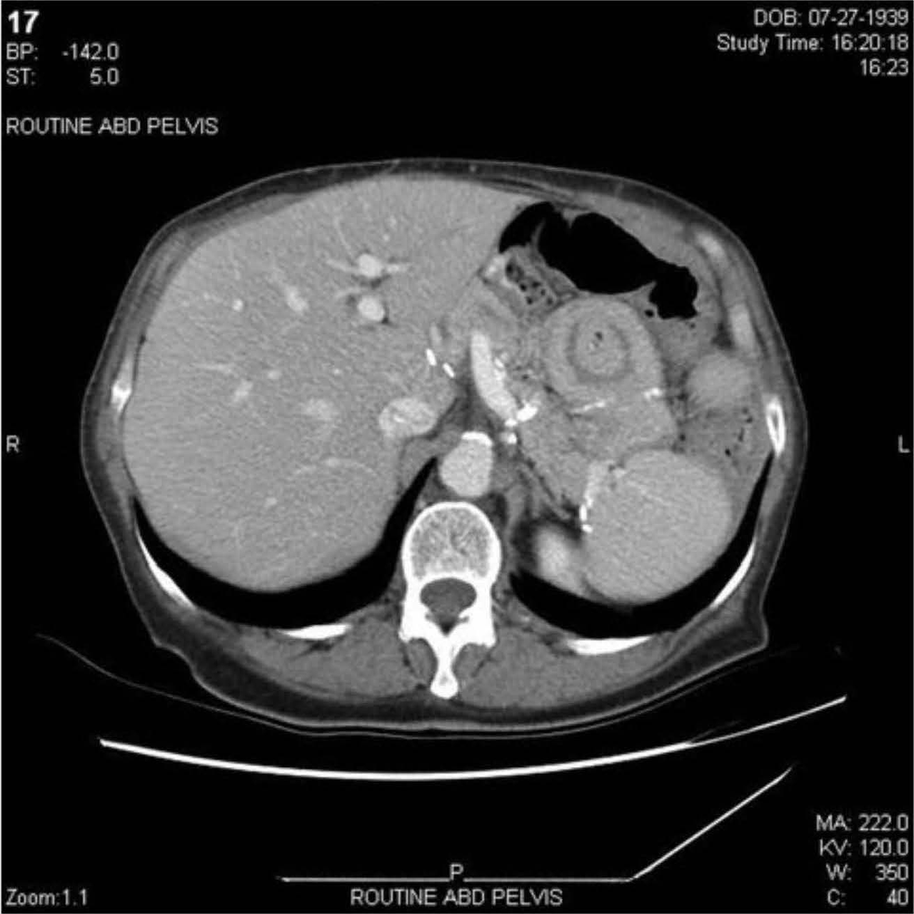 CT scan of the abdomen