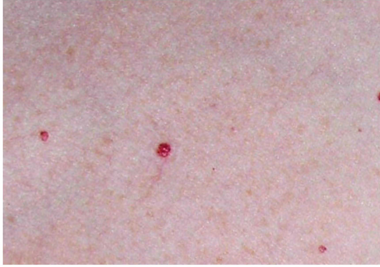 skin with multiple small red papules