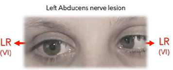 left abducens lesion