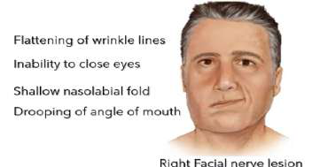 right facial lesion illustration